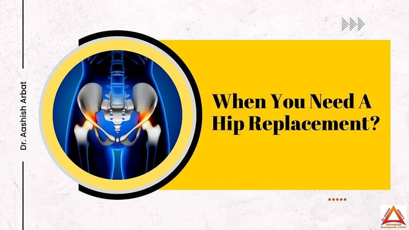 When You Need A Hip Replacement?