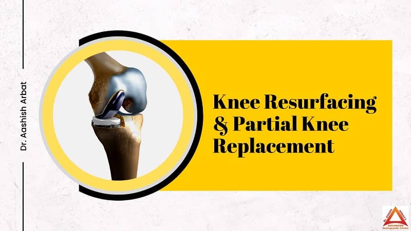 Knee Resurfacing and Partial Knee Replacement