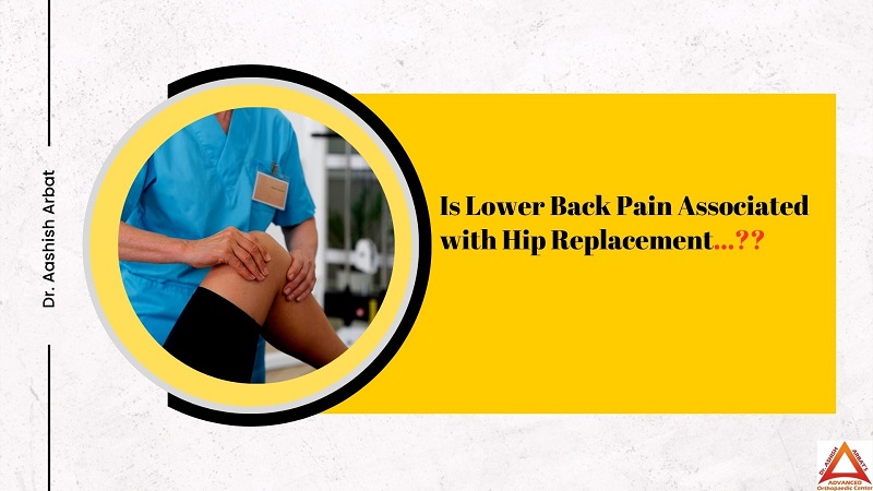 Is Lower Back Pain Associated with Hip Replacement