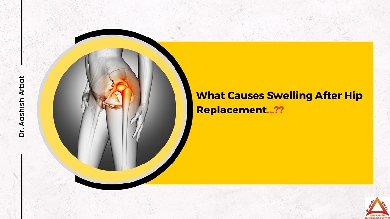 What Causes Swelling After Hip Replacement