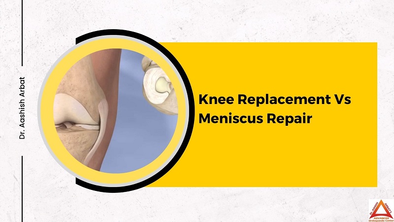 knee replacement vs meniscus repair