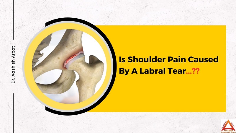 Is Shoulder Pain Caused By A Labral Tear