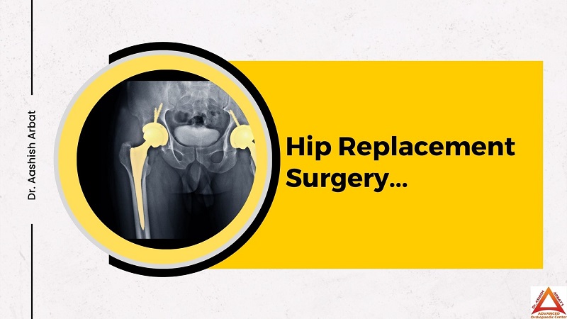 Hip Replacement surgery