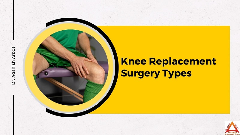 Knee Replacement Surgery Types