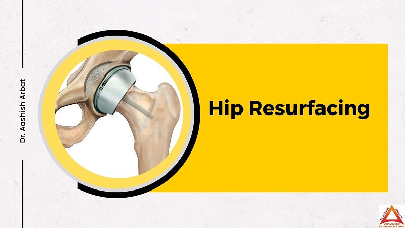 Hip Resurfacing