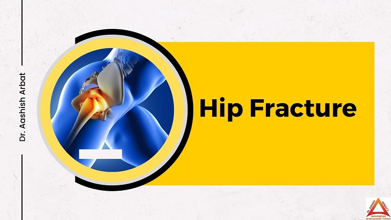 Hip Fracture