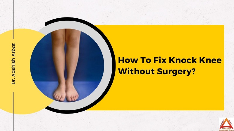How To Fix Knock Knee Without Surgery