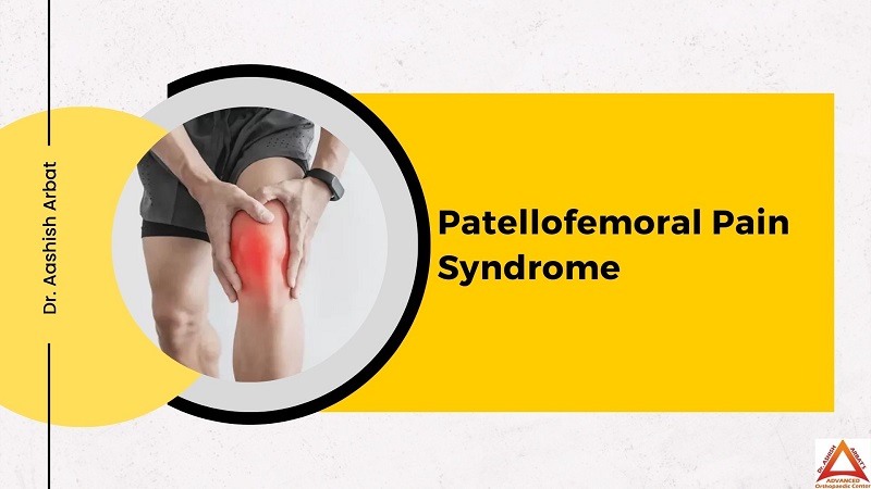 Patellofemoral Pain Syndrome
