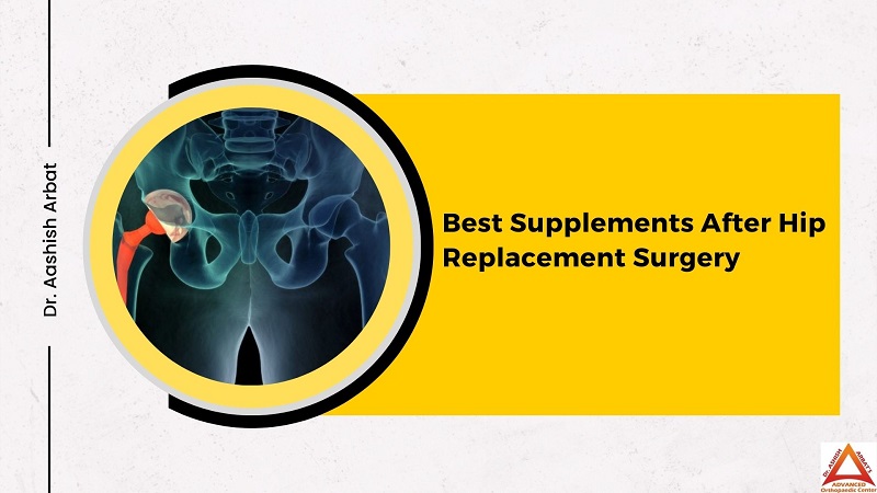 Best Supplements After Hip Replacement Surgery