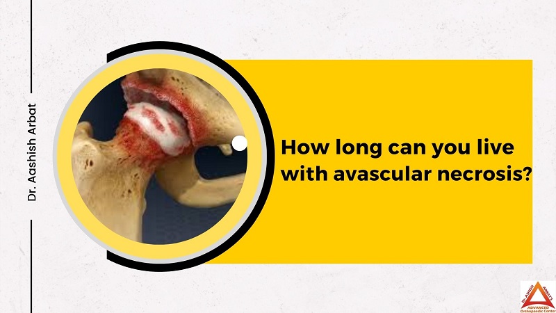 How Long Can You Live with Avascular Necrosis?