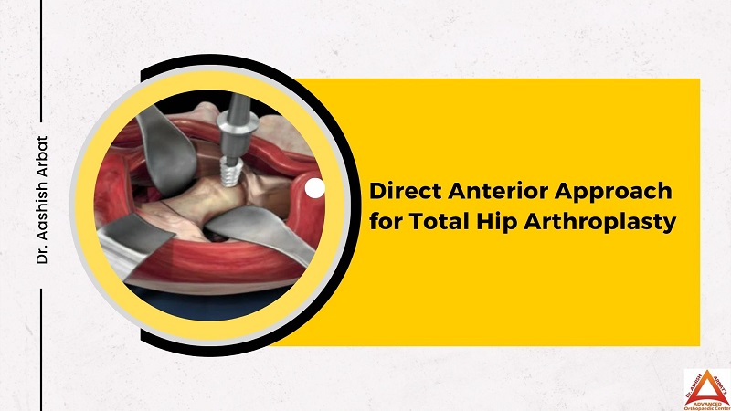 Direct Anterior Approach for Total Hip Arthroplasty